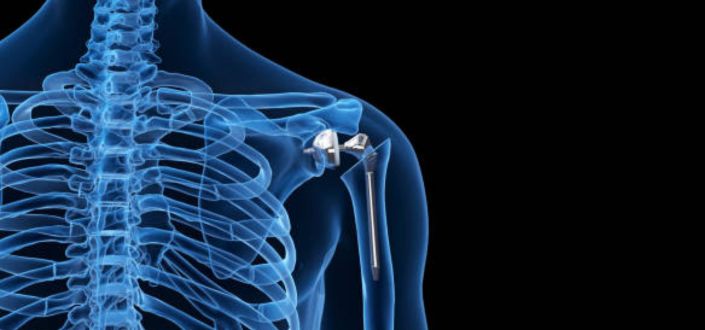 Dr. Álvaro Velarde e Dr. Carlos Galindo, publicam uma pesquisa científica no Journal of Orthopaedic Surgery and Research